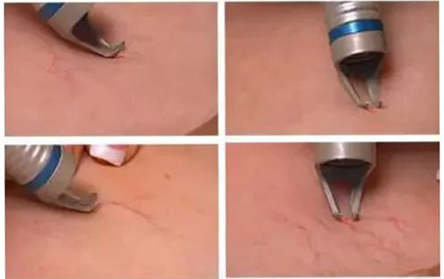 Effortless Spider Vein Removal with Advanced 980nm Diode Laser